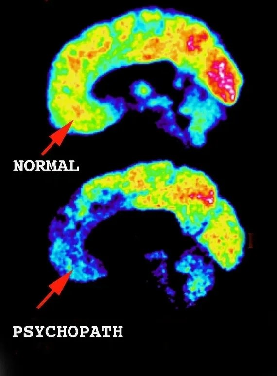 A picture of the same brain as in normal.